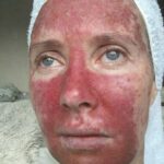 Derm-Biome Pharmaceuticals’ topical therapy shows positive results in preclinical skin cancer trial: drug prevents the development of precancerous skin conditions and treats existing skin cancers with no observable side effects